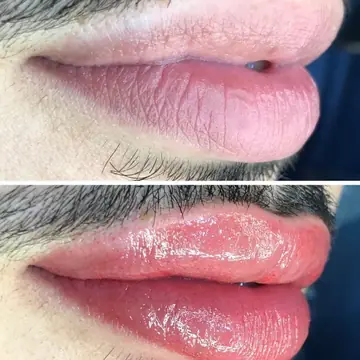 Revitalización Labial