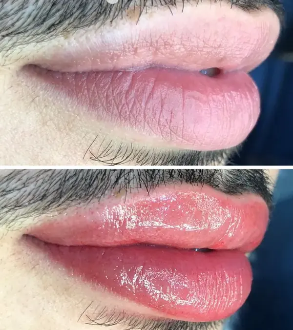 Revitalización Labial