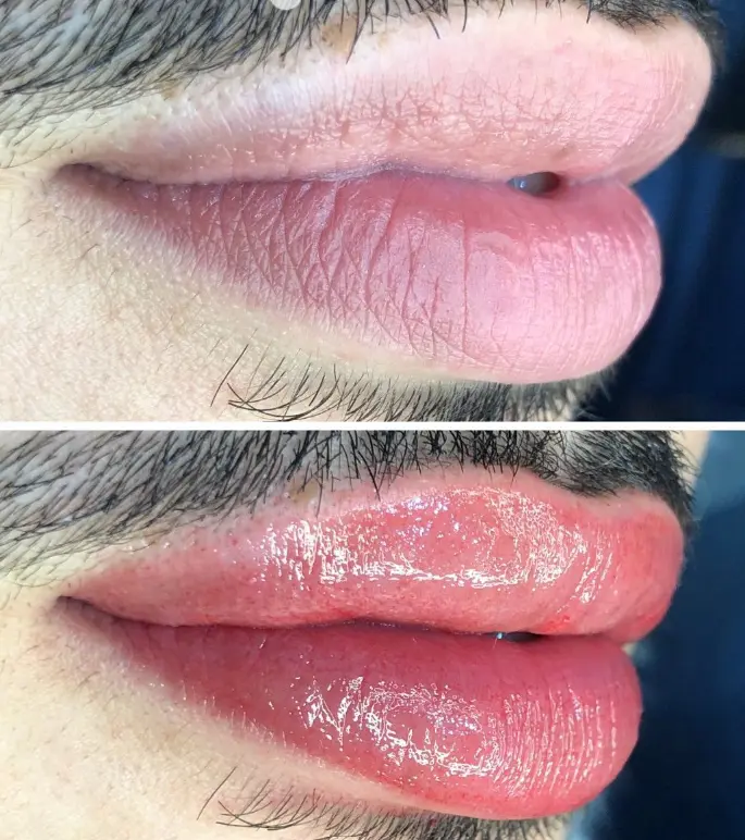 Revitalización Labial